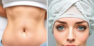 Три способа омоложения без скальпеля: Липолитики для живота, Безоперационная блефаропластика и Микроигольчатый RF-лифтинг