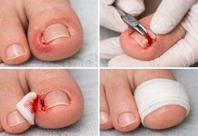 Вросший ноготь на большом пальце: как перестать терпеть и начать действовать