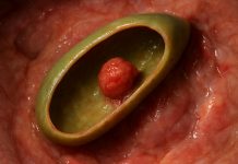 Полип желчного пузыря: что это такое и почему не стоит паниковать