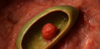 Полип желчного пузыря: что это такое и почему не стоит паниковать