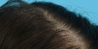 До проведения мезотерапий волос