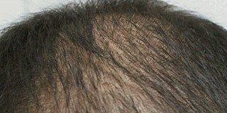 До проведения мезотерапий волос