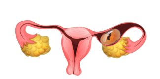 Внематочная беременность