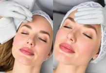 Филлеры для лица: разумный путь к обновлённому облику