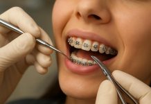 Установка брекетов: как пройти путь к ровной улыбке без лишнего нервного напряжения Установка брекетов: как пройти путь к ровной улыбке без лишнего нервного напряжения