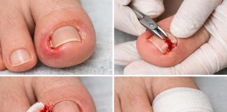 Вросший ноготь на большом пальце: как перестать терпеть и начать действовать